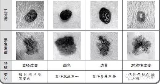 女子脚上黑痣成了恶性瘤，只因常做这件事……身上有痣的要看！